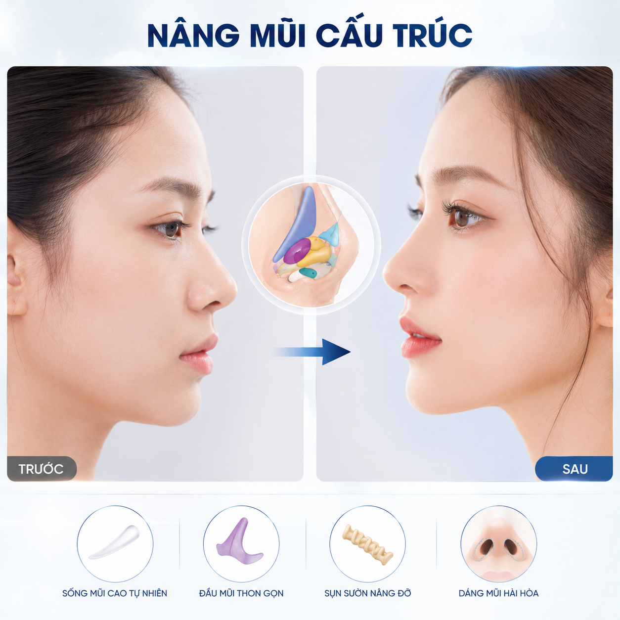 Nâng mũi cấu trúc tác động toàn diện đến cấu trúc mũi