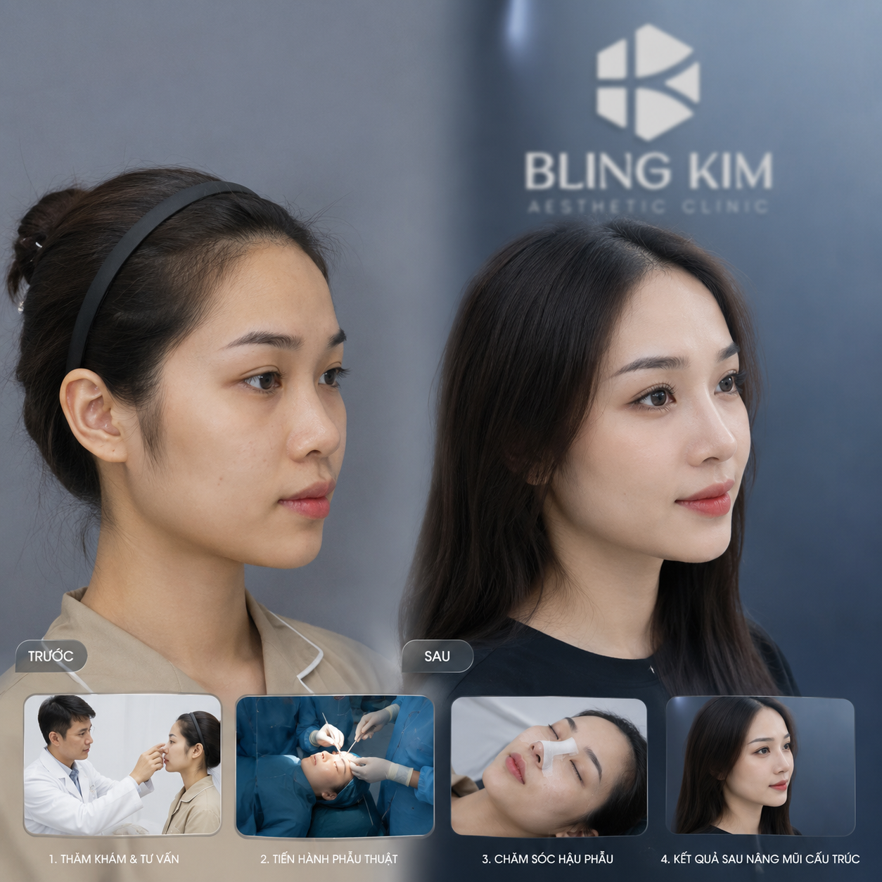 Nâng mũi cấu trúc có nhiều ưu điểm vượt trội hơn so với các phương pháp khác