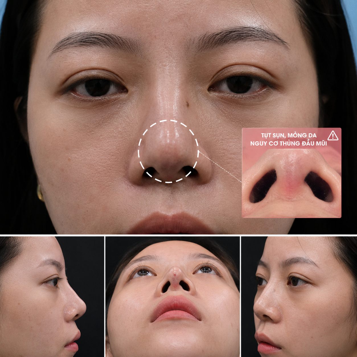 Mũi bị tụt sụn, mỏng da, có nguy cơ thủng đầu mũi nên cân nhắc nâng mũi cấu trúc