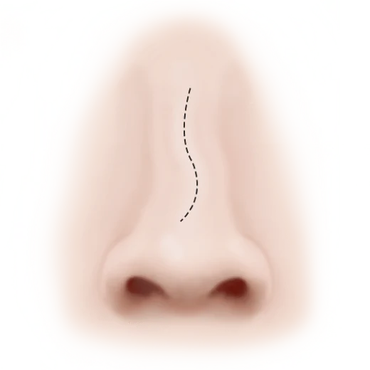 Mũi cong